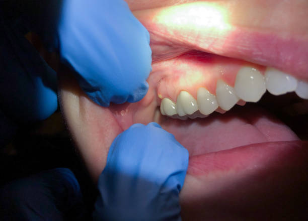 Best Emergency Dentist for Lost Fillings or Crowns in Albany, OR